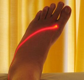 trajtimi me lazer i venave me variçe në këmbë
