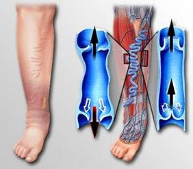 rrjedhja e gjakut në këmbë me venat me variçe