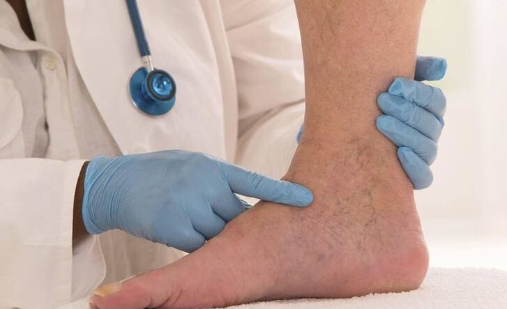 mjeku ekzaminon këmbën me venat me variçe