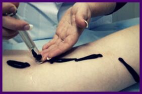 Procedura për trajtimin e venave me variçe me shushunja (hirudoterapi)