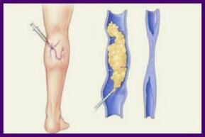 Skleroterapia është një metodë popullore për të hequr qafe venat me variçe në këmbë