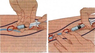 metodat e trajtimit të venave me variçe