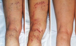 simptomat e venave me variçe në këmbë