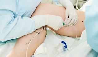 metodat e trajtimit të venave me variçe në këmbë tek gratë